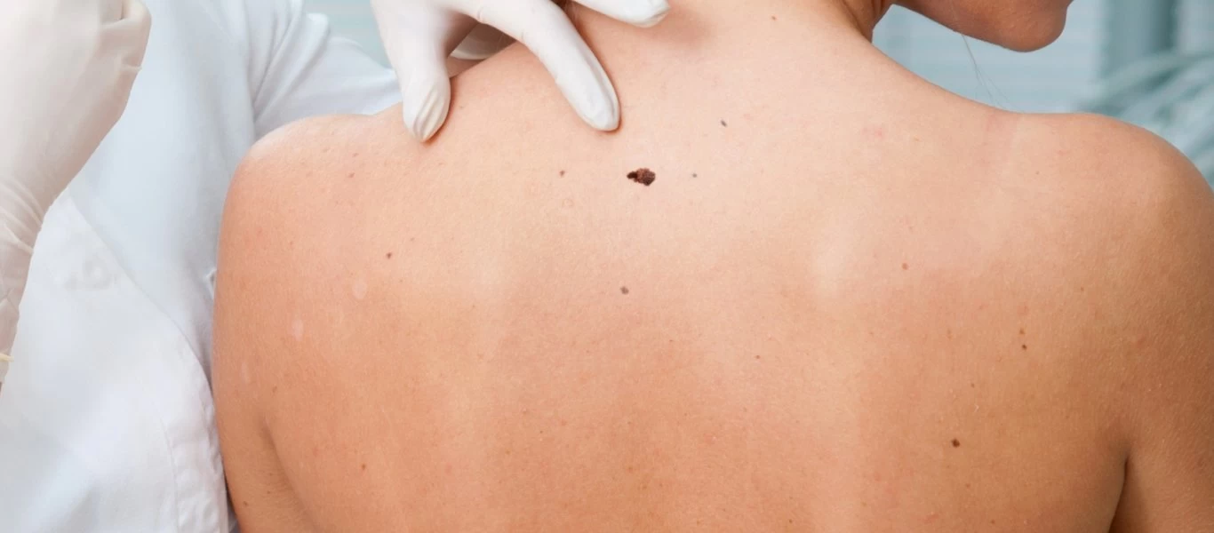 Καρκίνος του δέρματος: Πότε η φαγούρα σε μια ελιά πρέπει να σας ανησυχήσει